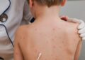 Vaksina e fruthit te fëmijët, mjeku tregon pasojat: Çfarë ndodh nëse pacienti ka ndërlikime