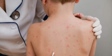 Vaksina e fruthit te fëmijët, mjeku tregon pasojat: Çfarë ndodh nëse pacienti ka ndërlikime