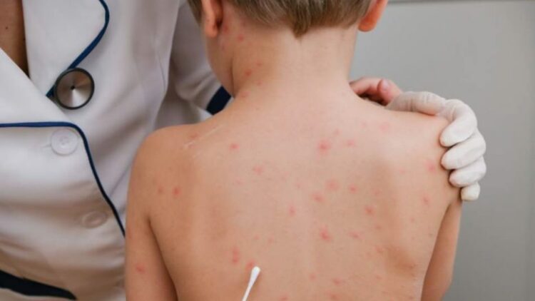 Vaksina e fruthit te fëmijët, mjeku tregon pasojat: Çfarë ndodh nëse pacienti ka ndërlikime