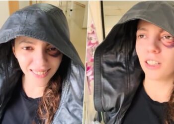 U plagos në sy gjatë protestës, Eva Pango del nga Spitali i Traumës: Më e motivuar se kurrë!