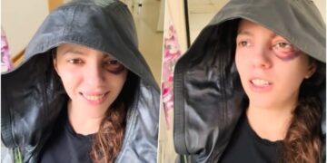 U plagos në sy gjatë protestës, Eva Pango del nga Spitali i Traumës: Më e motivuar se kurrë!