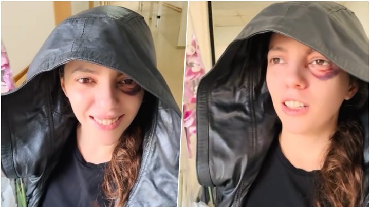 U plagos në sy gjatë protestës, Eva Pango del nga Spitali i Traumës: Më e motivuar se kurrë!