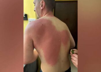 Gazetari Klevin Muka u lëndua nga uji me solucion, Berisha dënon sulmin: Akt kriminal dhe hakmarrje primitive