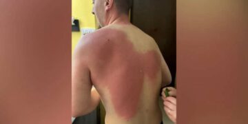 Gazetari Klevin Muka u lëndua nga uji me solucion, Berisha dënon sulmin: Akt kriminal dhe hakmarrje primitive