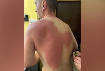 Lëndimi i gazetarit Klevin Muka, reagon SafeJournalists: Kërkojmë hetim të pavarur dhe llogaridhënie për veprimet e Policisë